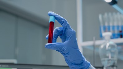 Resultados divulgados no Blood Cancer Journal foram obtidos por pesquisadores da USP em testes com células de pacientes (foto: Freepik)