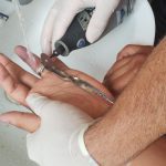 Anéis presos aos dedos levam mais de 400 por ano aos Bombeiros