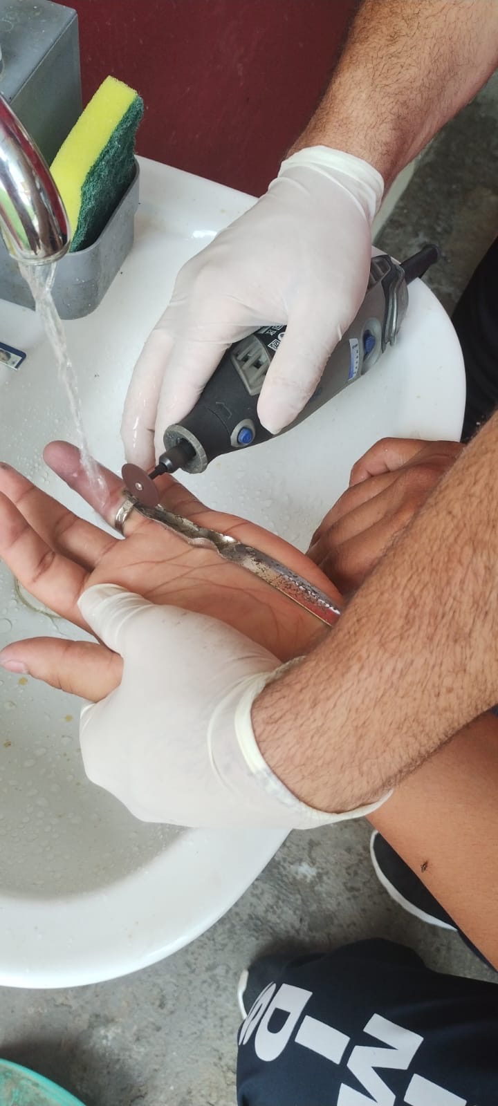 Anéis presos aos dedos levam mais de 400 por ano aos Bombeiros