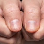 Conheça 4 alterações nas unhas que podem indicar problemas de saúde