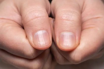 Conheça 4 alterações nas unhas que podem indicar problemas de saúde