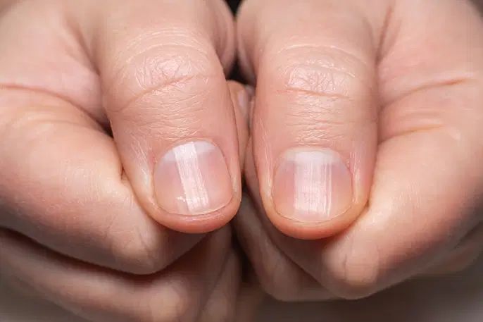 Conheça 4 alterações nas unhas que podem indicar problemas de saúde