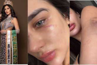 Vídeo: Miss Amazonas denuncia ex-namorado após surgir cheia de hematomas pelo corpo