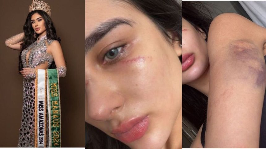 Vídeo: Miss Amazonas denuncia ex-namorado após surgir cheia de hematomas pelo corpo
