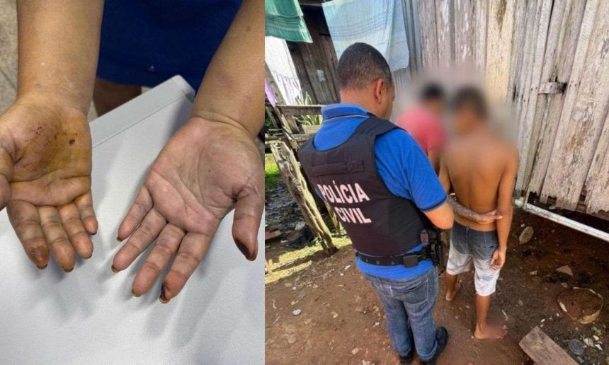 Mãos de uma mulher com marcas de queimaduras, lado a lado com um policial civil prendendo um suspeito de tortura.