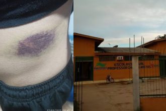 Uma pessoa com uma grande marca roxa no corpo, que parece ser um hematoma, e uma escola com a fachada amarela.