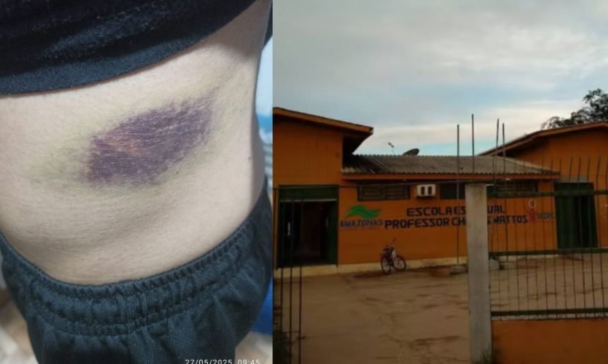 Uma pessoa com uma grande marca roxa no corpo, que parece ser um hematoma, e uma escola com a fachada amarela.