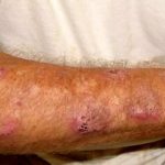 Braço com lesões de esporotricose humana, doença fúngica comum no Amazonas.