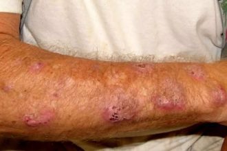 Braço com lesões de esporotricose humana, doença fúngica comum no Amazonas.