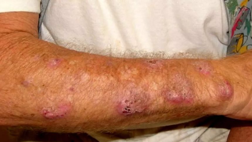 Braço com lesões de esporotricose humana, doença fúngica comum no Amazonas.