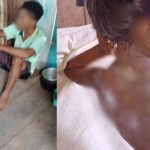 Jovem sentado no chão e criança com ferimentos nas costas por mingau quente, possivelmente em situação de vulnerabilidade.