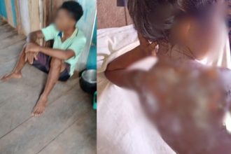 Jovem sentado no chão e criança com ferimentos nas costas por mingau quente, possivelmente em situação de vulnerabilidade.