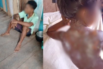 Jovem sentado no chão e criança com ferimentos nas costas por mingau quente, possivelmente em situação de vulnerabilidade.