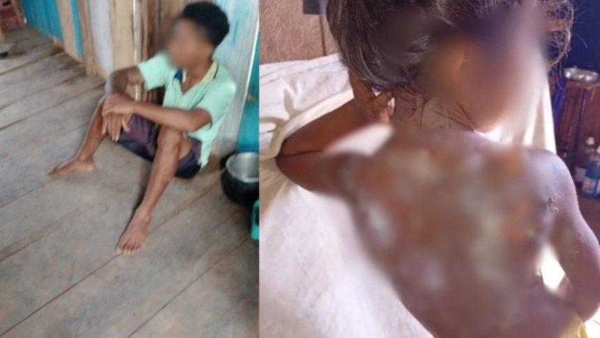 Jovem sentado no chão e criança com ferimentos nas costas por mingau quente, possivelmente em situação de vulnerabilidade.