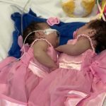 Gêmeas siamesas Yasmin Vitória e Eliza Vitória em vestidos rosa na UTI