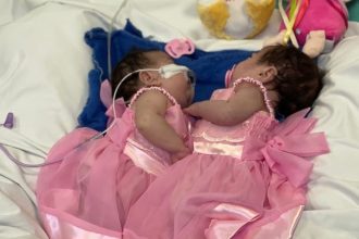 Gêmeas siamesas Yasmin Vitória e Eliza Vitória em vestidos rosa na UTI