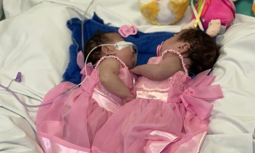 Gêmeas siamesas Yasmin Vitória e Eliza Vitória em vestidos rosa na UTI