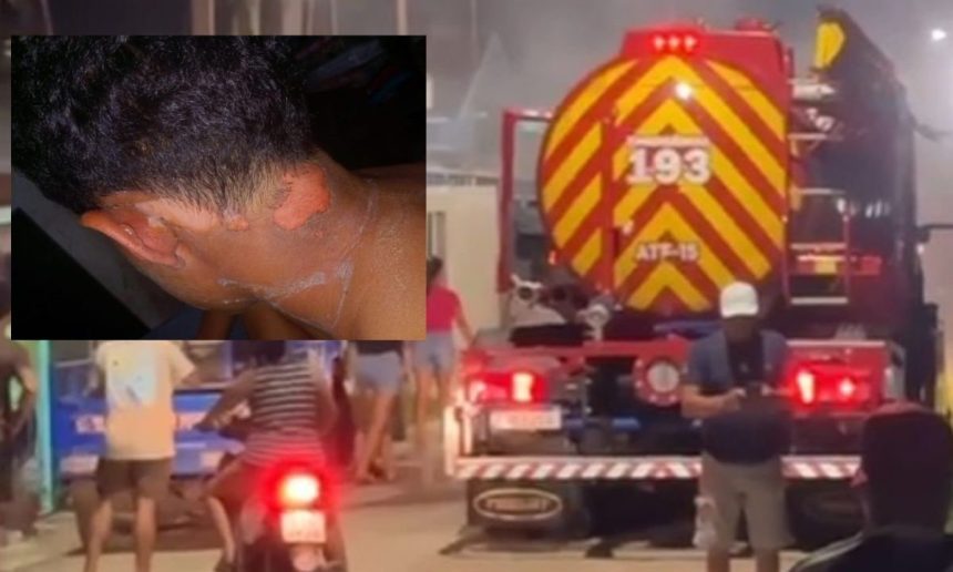 Ferimentos na pele de uma pessoa e um caminhão de bombeiros ao fundo