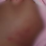 Imagem mostra pele com marcas avermelhadas, possivelmente lesões.