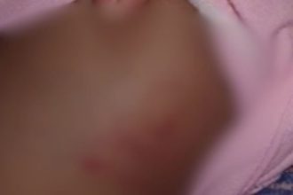 Imagem mostra pele com marcas avermelhadas, possivelmente lesões.