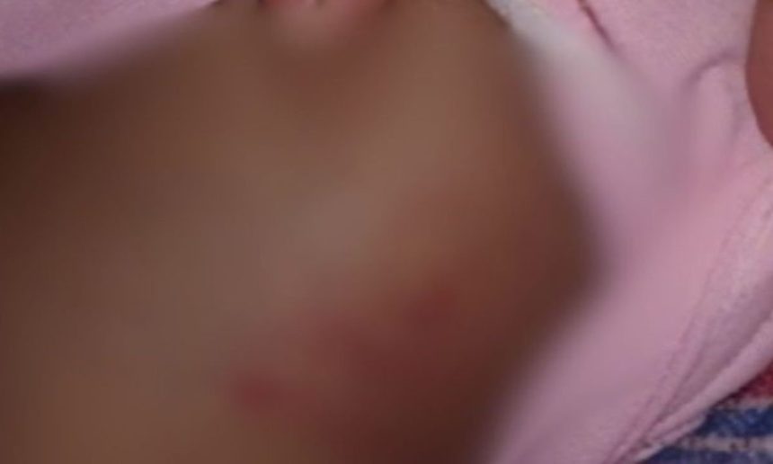 Imagem mostra pele com marcas avermelhadas, possivelmente lesões.