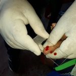Coleta de sangue para teste de malária em Manaus.