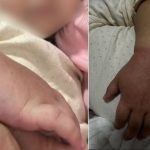 Menina de 2 anos quase perde braço após prender com elásticos de cabelo em Manaus