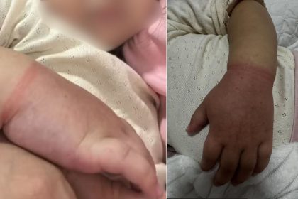 Menina de 2 anos quase perde braço após prender com elásticos de cabelo em Manaus