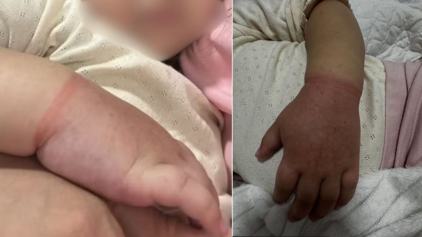 Menina de 2 anos quase perde braço após prender com elásticos de cabelo em Manaus