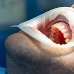 Boca de paciente em consultório odontológico com afastador de bochechas.