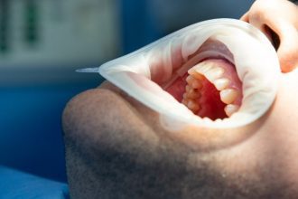 Boca de paciente em consultório odontológico com afastador de bochechas.