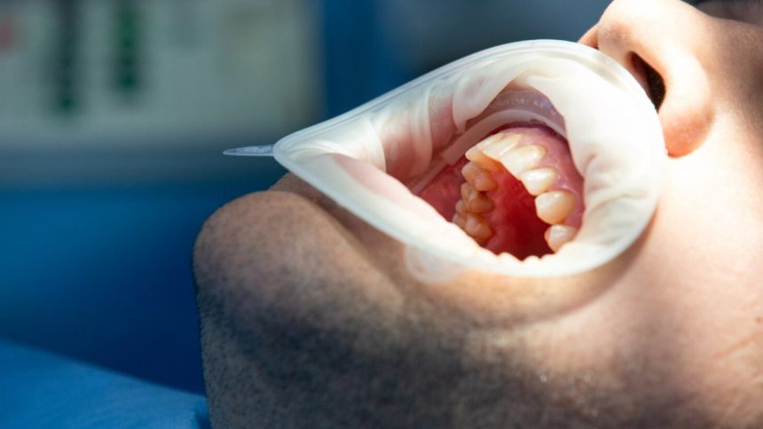 Boca de paciente em consultório odontológico com afastador de bochechas.