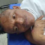 Paciente em leito hospitalar com ferimentos e suturas na cabeça.