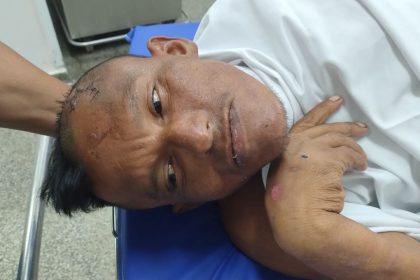 Paciente em leito hospitalar com ferimentos e suturas na cabeça.