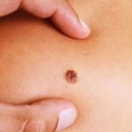 Campanha de prevenção em Manaus alerta sobre sinais do câncer de pele