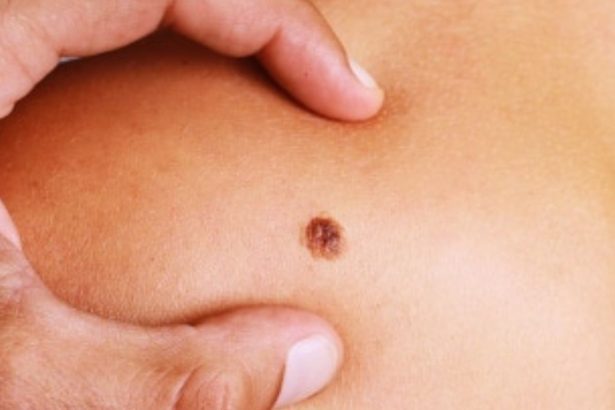 Campanha de prevenção em Manaus alerta sobre sinais do câncer de pele