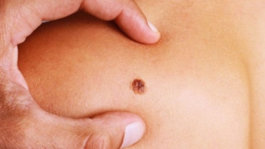 Campanha de prevenção em Manaus alerta sobre sinais do câncer de pele