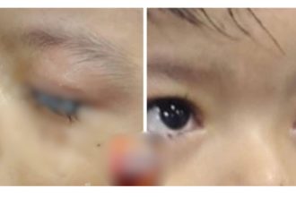 Menino de 2 anos tem olhos colados por cola industrial em Parintins