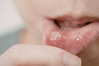 Carnaval exige atenção redobrada com a saúde bucal, alerta especialista