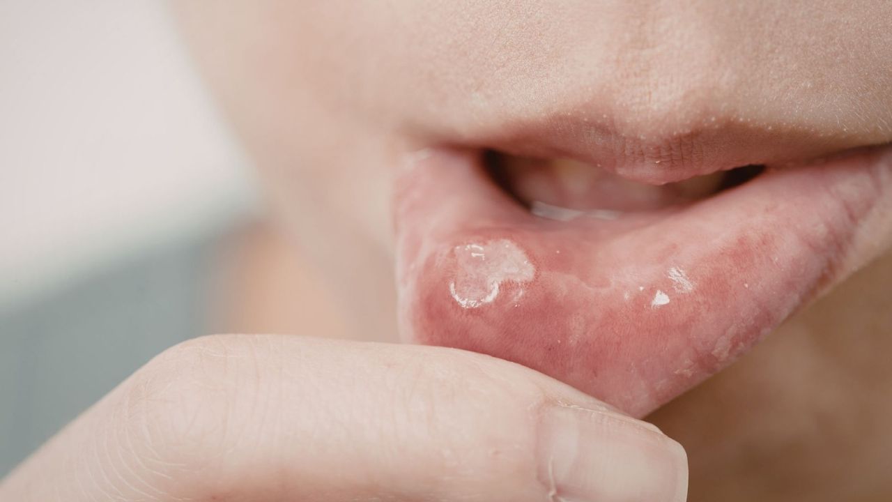 Carnaval exige atenção redobrada com a saúde bucal, alerta especialista