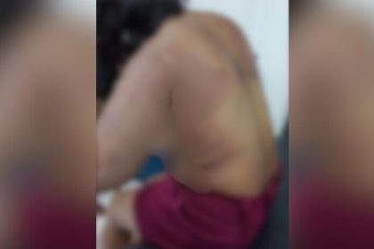Homem ateia fogo na ex e no filho dela em Parintins; vítimas estão em estado grave