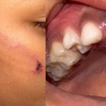 Criança perde dente após ser agredida com corda pela mãe em Presidente Figueiredo