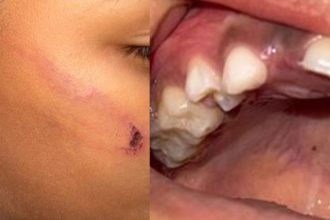 Criança perde dente após ser agredida com corda pela mãe em Presidente Figueiredo