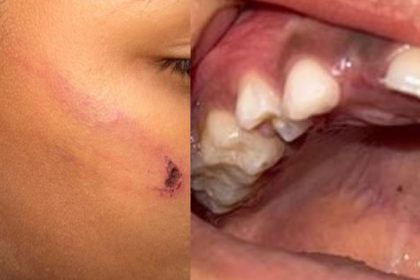 Criança perde dente após ser agredida com corda pela mãe em Presidente Figueiredo