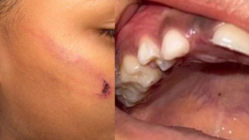 Criança perde dente após ser agredida com corda pela mãe em Presidente Figueiredo