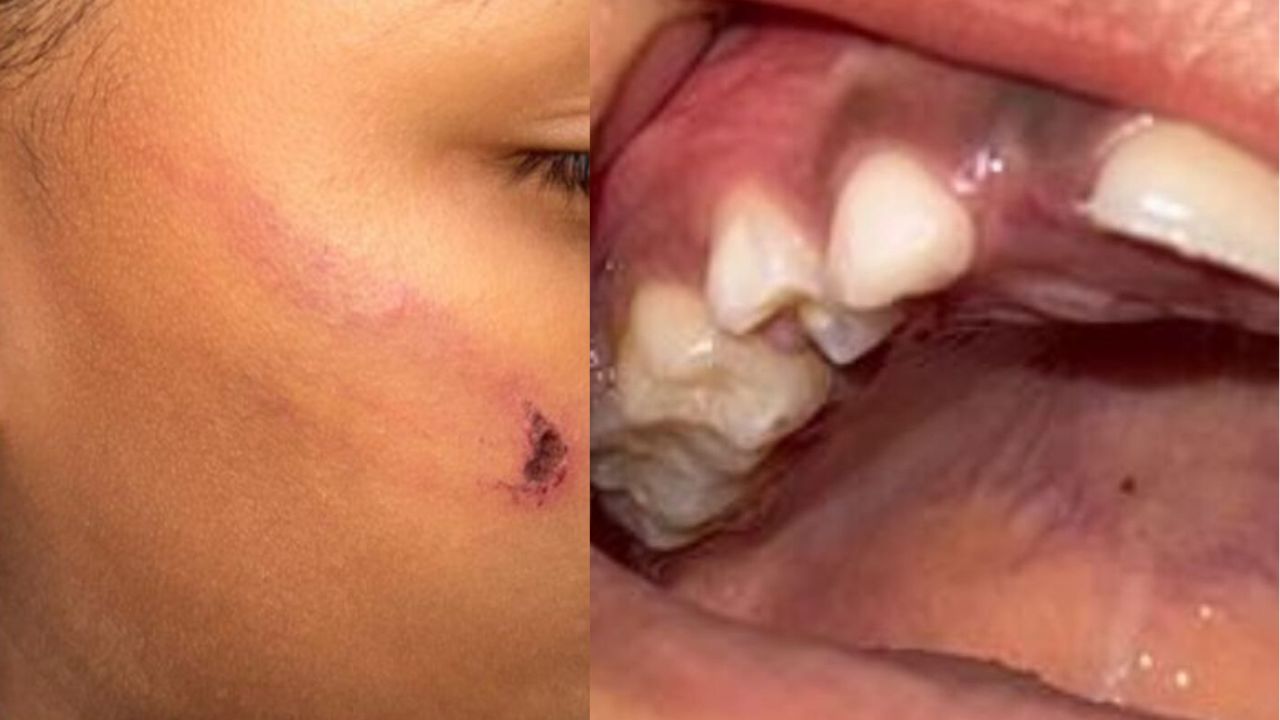 Criança perde dente após ser agredida com corda pela mãe em Presidente Figueiredo