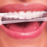 Fitas de clareamento dental estão proibidas pela Anvisa