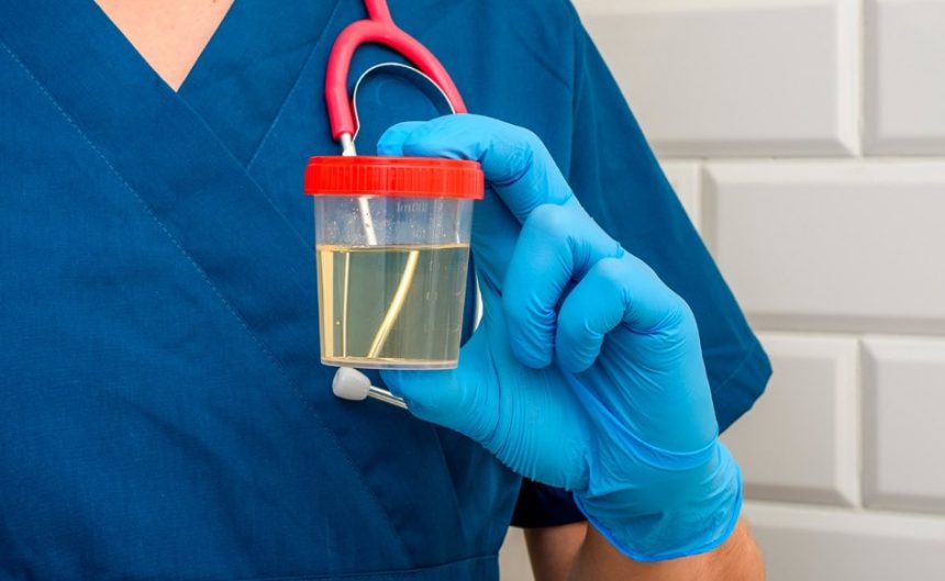 O que cor da urina revela sobre saúde e quando buscar um médico