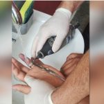 Manaus registra aumento de ocorrências com anéis presos e ultrapassa 500 casos