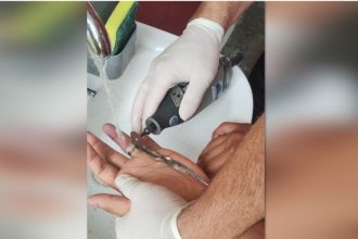 Manaus registra aumento de ocorrências com anéis presos e ultrapassa 500 casos